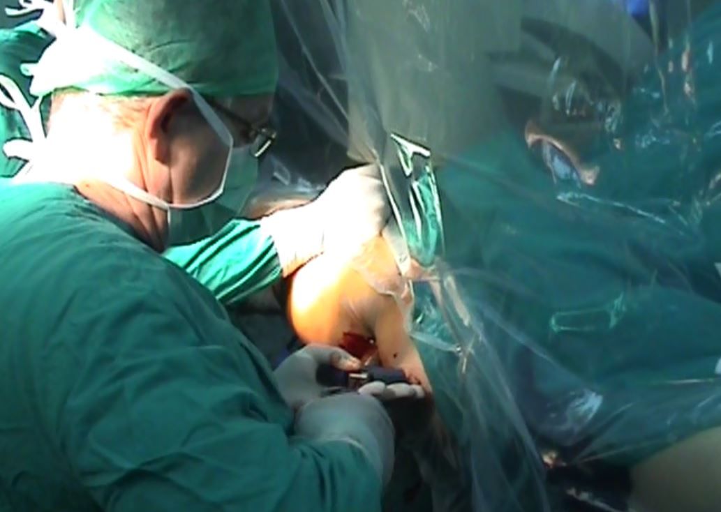 Svjetski uspjeh kardiokirurga: djevojci iz Varaždina iz srca odstranjen rijedak zloćudni tumor